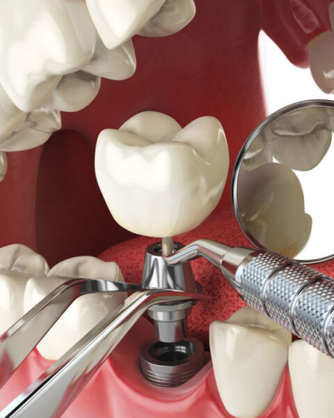 Dental Implant Services Near You | Apple Dental Implant Centre