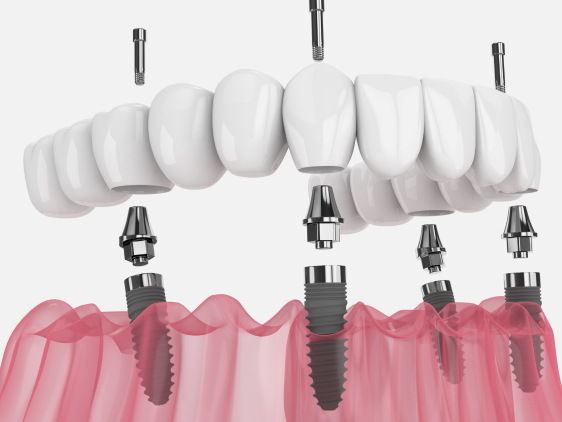 Single Dental Implant