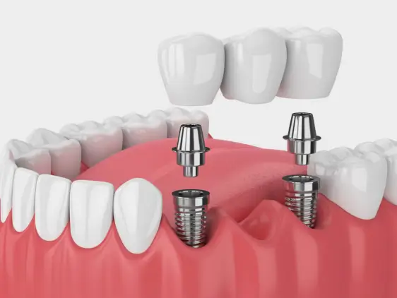 multiple-tooth-replacement