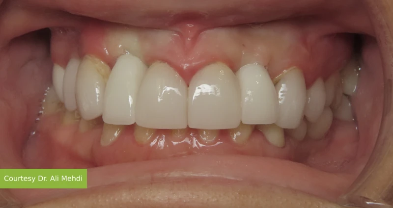 After treatment