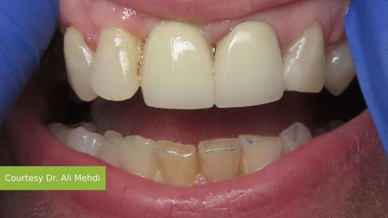 After treatment