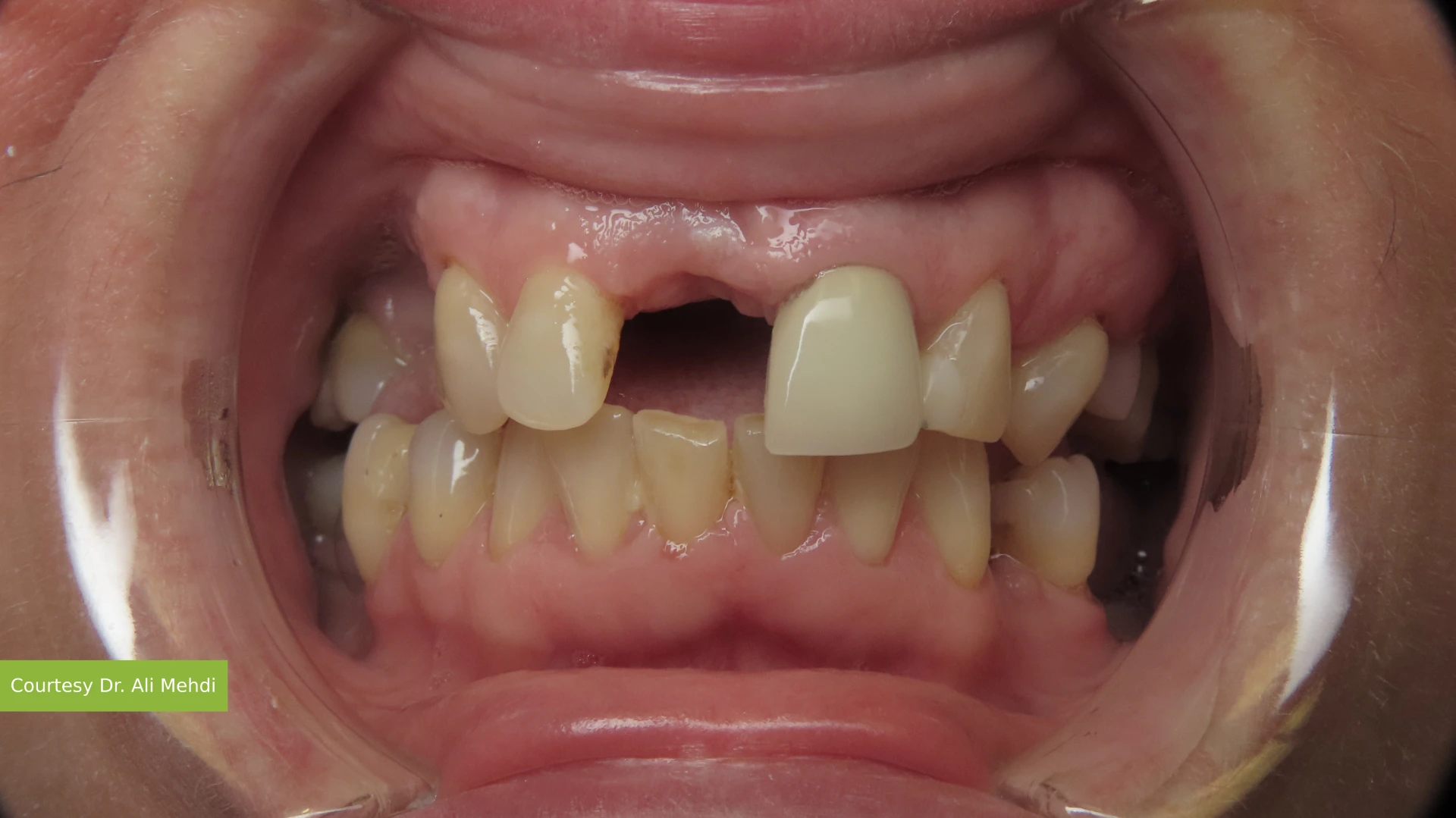 Before treatment